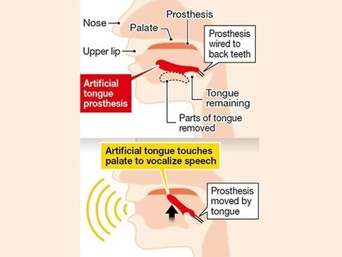 В Японии разрабатывают протез языка