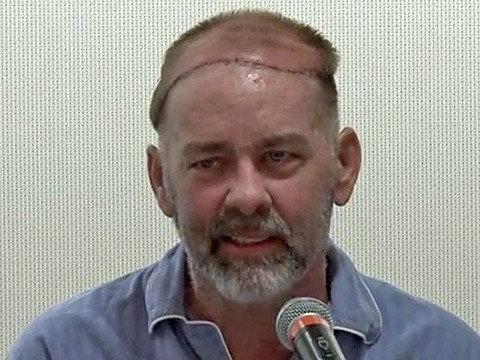 Как правильно снимать скальп Американские врачи впервые провели пересадку черепа и скальпа - новости медицины