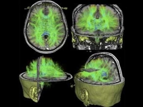 Новая методика поможет выявить [повреждение нейронных путей при травме головы]