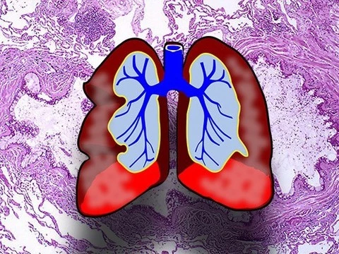 Обострение астмы связали с микробиомом дыхательных путей