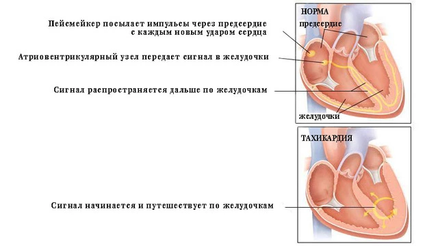Источник: https://www.drugs.com/health-guide/tachycardia.html