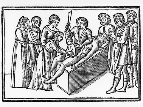 Первая успешная операция кесарева сечения состоялась в 1337 году