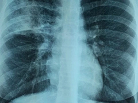 «Не надо нам мешать!»: фтизиатр об опасности отказа от прививок и туберкулинодиагностики