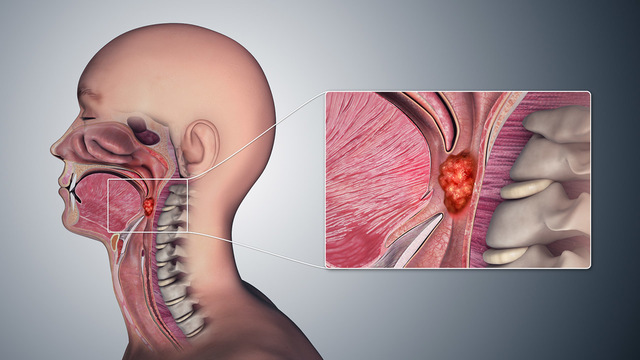 Рак полости рта: признаки и симптомы