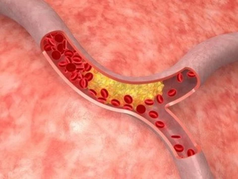 [Найден новый подход] к лечению атеросклероза
