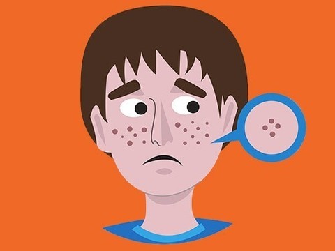 Ученые рассказали, какие продукты способствуют появлению угревой сыпи