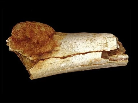 Обнаружена самая древняя злокачественная опухоль