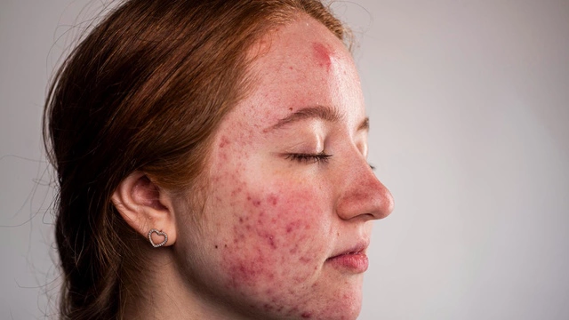 Чем нельзя умываться при акне? Советы дерматолога подросткам