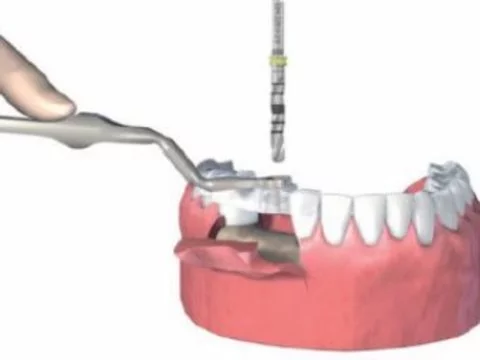 [Американский стоматолог] дважды потерял инструменты во рту пожилого пациента