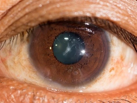 Глазные капли против катаракты успешно протестированы на мышах