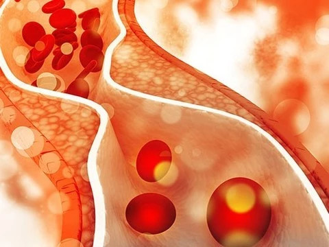 Как холестерин способствует метастазированию рака груди и других видов рака