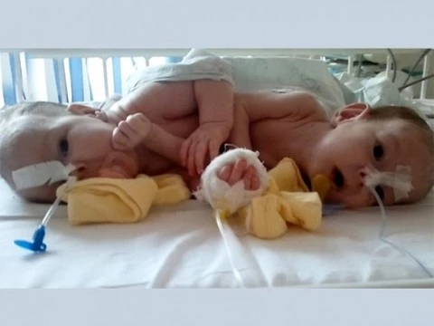 В Москве прооперировали сиамских близнецов с общими желчными путями и кишечником