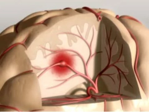 [Раскрыт механизм] защиты мозга от инсульта