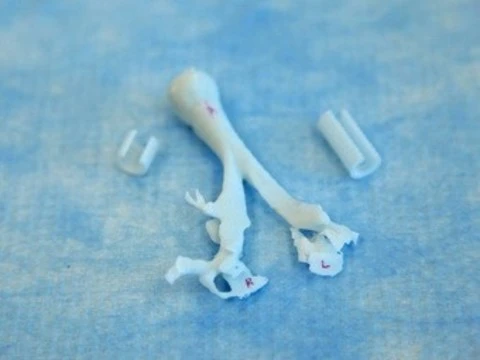 Напечатанная на 3D-принтере конструкция [спасла ребенку жизнь]
