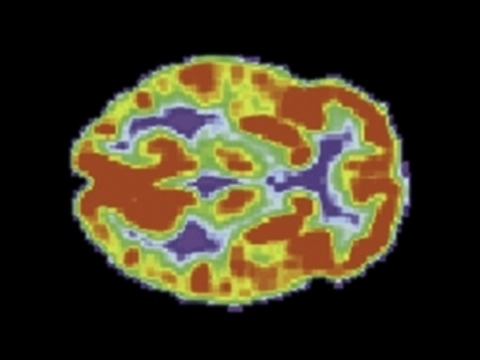 Власти США одобрили [радиофармпрепарат для диагостики болезни Альцгеймера]