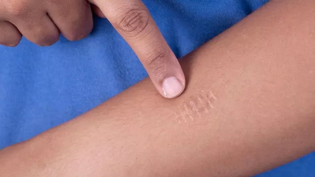 Новые возможности в коррекции шрамов: роль иммобилизованной гиалуронидазы