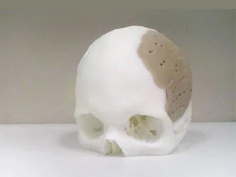 75 процентов черепа американца [заменили распечатанным на 3D-принтере имплантом]