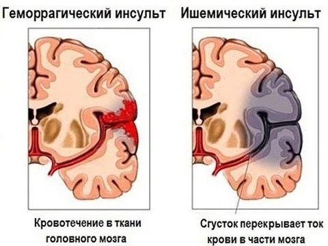 ВЦИОМ выяснил, что россияне знают об инсульте