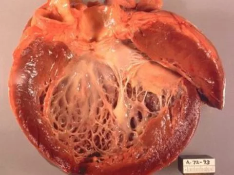 [Открыт механизм] возникновения послеродовой сердечной недостаточности