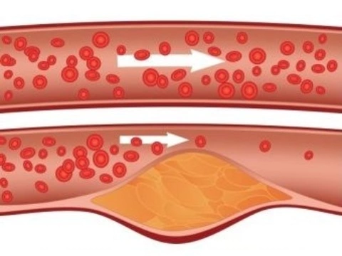 Американцы успешно испытали [новые препараты для снижения холестерина]