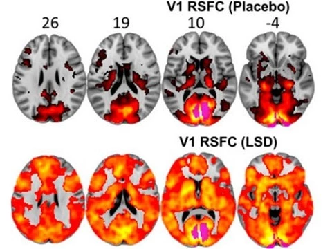 Мозг человека под ЛСД изучили с помощью МРТ