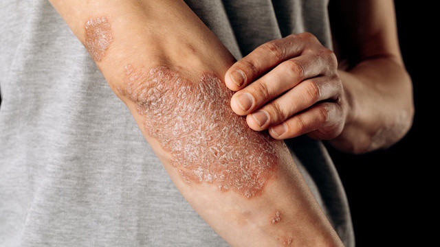 Можно ли вылечить псориаз? Объясняет дерматолог