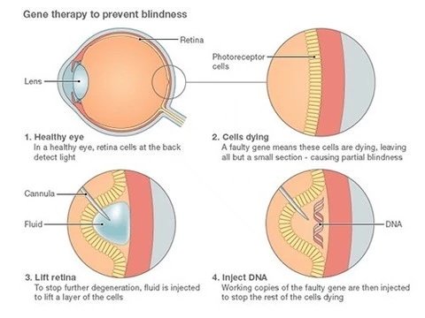 Генная терапия спасла от слепоты