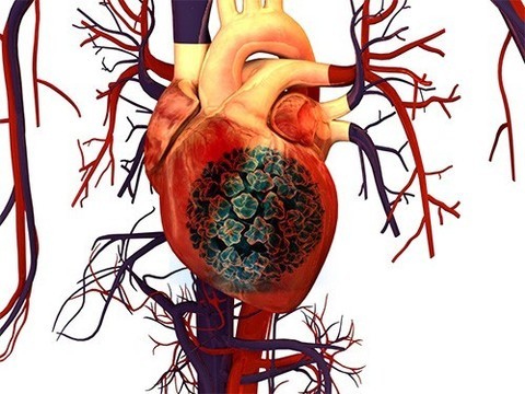 Инфицирование опасными типами ВПЧ может говорить о высоком риске болезней сердца