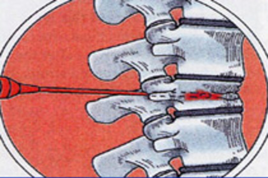 Укрепление позвонка с помощью костного цемента облегчает боли в спине