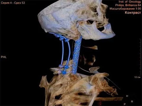 В Санкт-Петербурге впервые в мире метастазированные шейные позвонки заменили эндопротезом