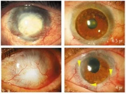 Стволовые клетки [восстановили зрение десяткам пациентов с ожогами глаз]
