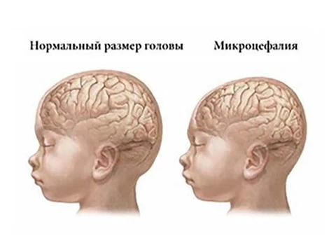 В Бразилии в пять раз возросло количество новорожденных с микроцефалией